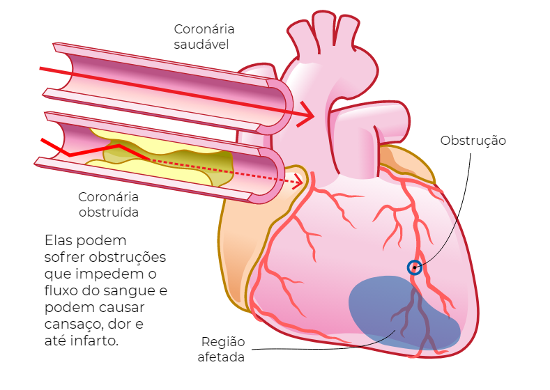 Infarto Cardiologista Dr. Gilberto Nunes | Porto Alegre angina