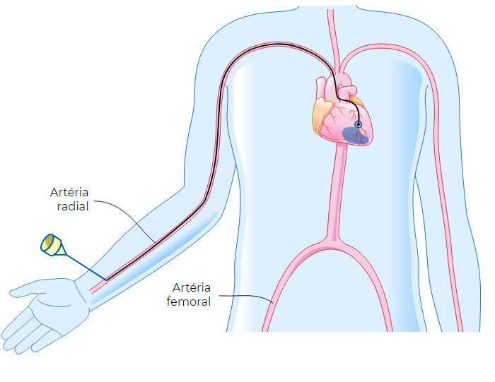 Cateterismo Cardíaco | Cardiologista Porto Alegre