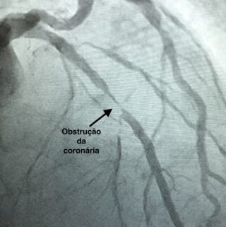 Cateterismo Cardiologista Dr. Gilberto Nunes | Porto Alegre Estenose
