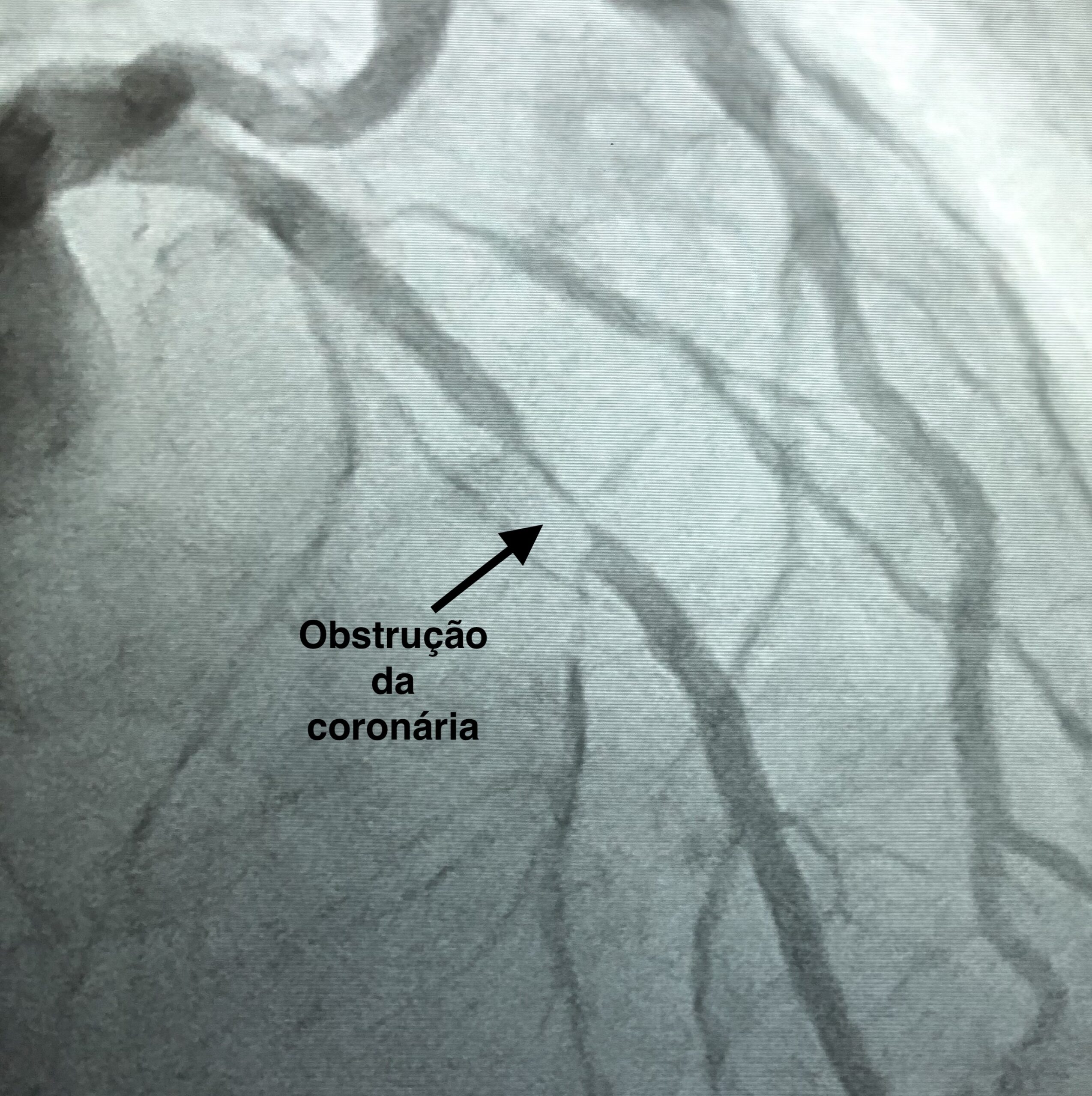 Doença Cardiovascular Cardiologista Dr. Gilberto Nunes | Porto Alegre Estenose scaled