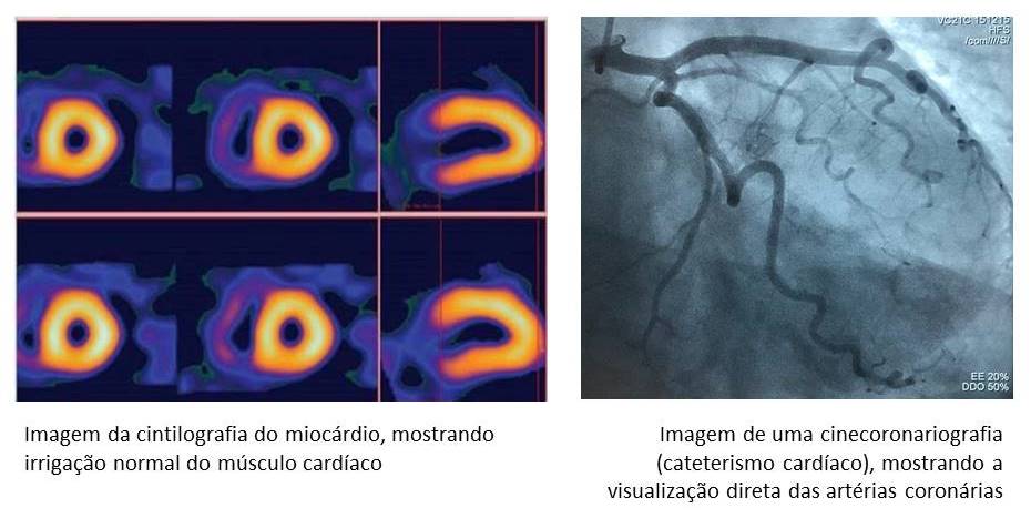 Notícias Cardiologista Dr. Gilberto Nunes | Porto Alegre cintilografia ou cateterismo