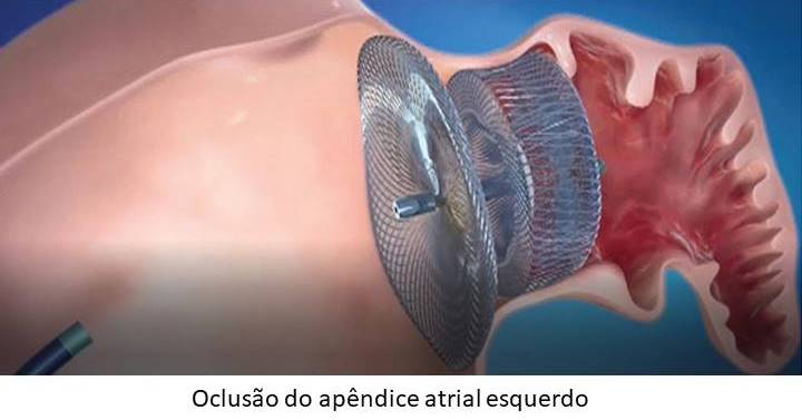 Infarto Cardiologista Dr. Gilberto Nunes | Porto Alegre item 5
