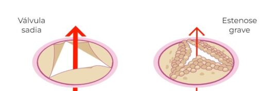 O que é o espessamento valvar aórtico? - Cardiologista Dr. Gilberto Nunes