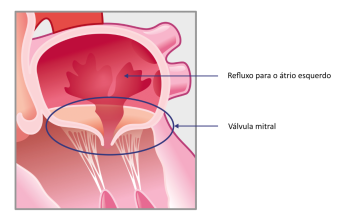 tratamento clip mitral 1 - cardiologista porto alegre dr gilberto nunes