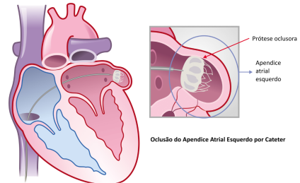 Cardiologista Cardiologista Dr. Gilberto Nunes | Porto Alegre tratamento clip mitral 4 cardiologista porto alegre dr gilberto nunes