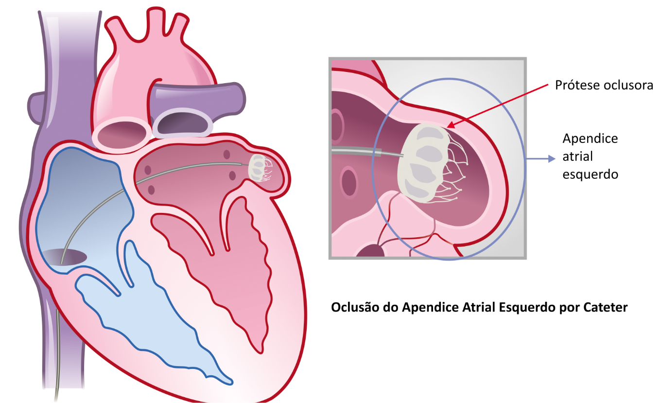 Cateterismo Cardiologista Dr. Gilberto Nunes | Porto Alegre tratamento clip mitral 4 cardiologista porto alegre dr gilberto nunes