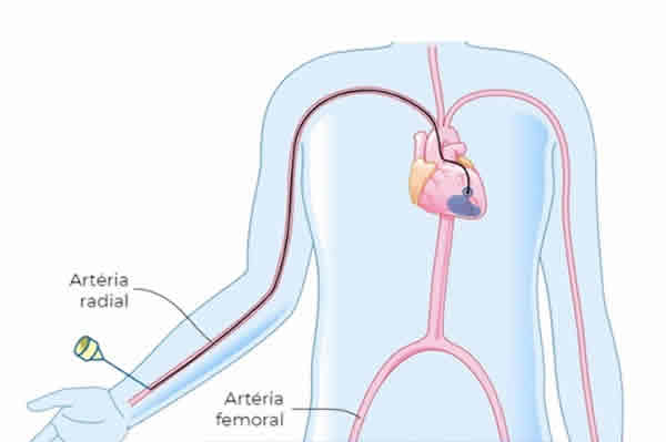 Angioplastia - Cardiologista Porto Alegre