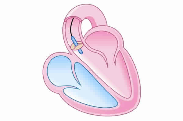 Estenose - Cardiologista Porto Alegre