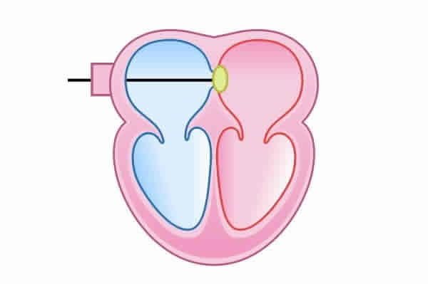 Cardiologista Dr. Gilberto Nunes | Porto Alegre Isquemia Cardiologista Porto Alegre