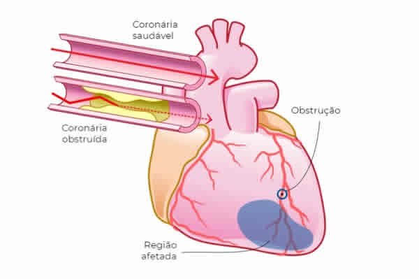 Cardiologista Dr. Gilberto Nunes | Porto Alegre Obstrucao Cardiologista Porto Alegre