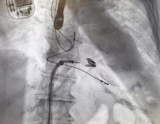 Tratamento por cateter reduz insuficiência tricúspide de torrencial para leve em paciente de 87 anos 1 | Cardiologista Dr. Gilberto Nunes Cateterismo Cardiologista Dr. Gilberto Nunes | Porto Alegre 290926 dois clipes liberados
